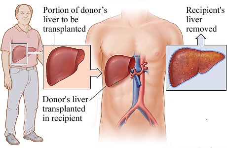 Liver Transplant